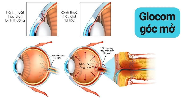 Glocom góc mở đặc trưng bởi sự tăng nhãn áp 