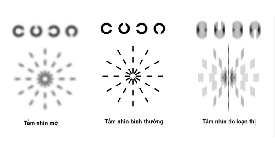 Tầm nhìn của mắt do loạn thị