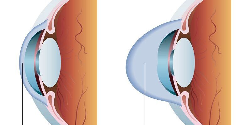 Tìm hiểu về bệnh giác mạc hình chóp (Keratoconus)