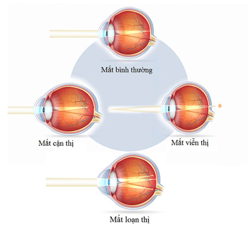 Cấu trúc mắt bị cận, viễn, loạn