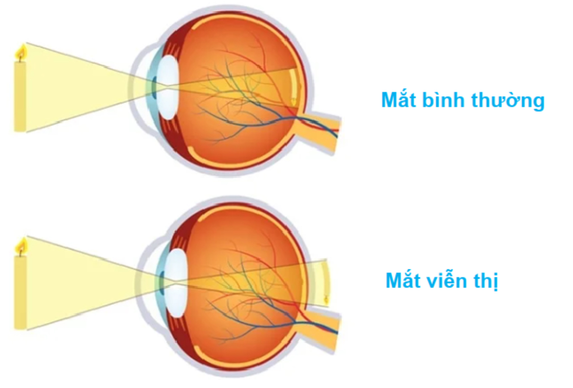 Trẻ bị viễn thị nặng gặp khó khăn khi nhìn các vật ở gần