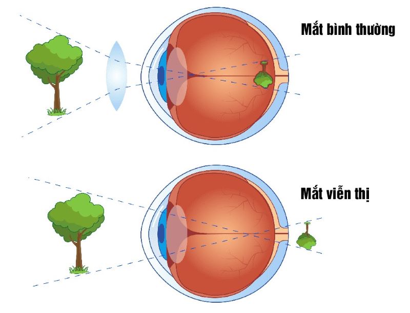 Mắt bình thường và mắt viễn thị