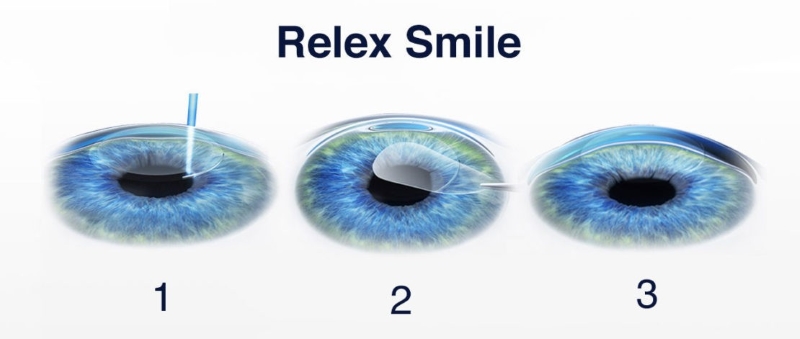 Phương pháp phẫu thuật RELEX SMILE chữa viễn thị