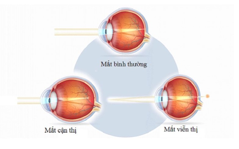 Trục nhãn cầu quá ngắn có thể gây bệnh viễn thị