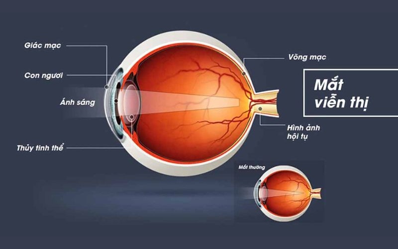 Viễn thị là gì?