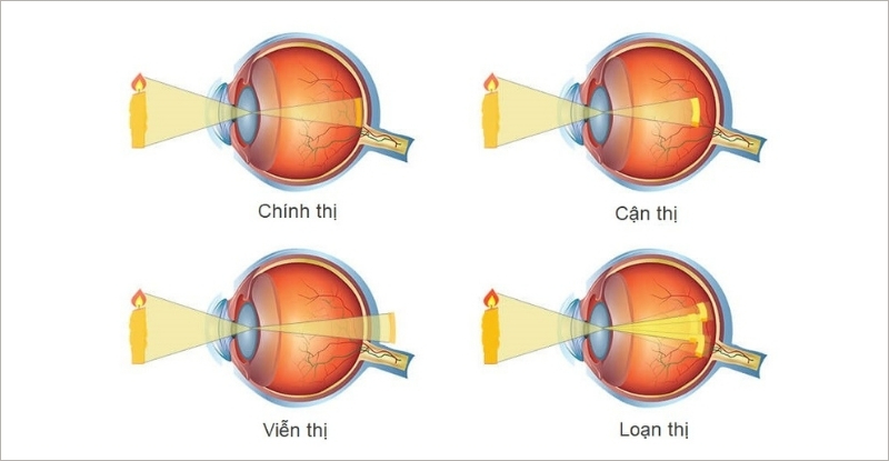 Trẻ nhỏ có nguy cơ gặp về vấn đề tật khúc xạ như cận thị, viễn thị và loạn thị