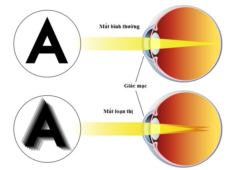 Mắt bị loạn thị