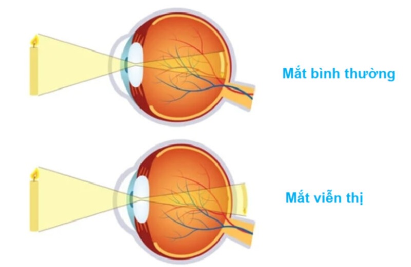 Viễn thị là gì?