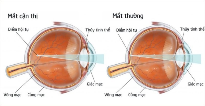 Mắt cận thị và mắt bình thường