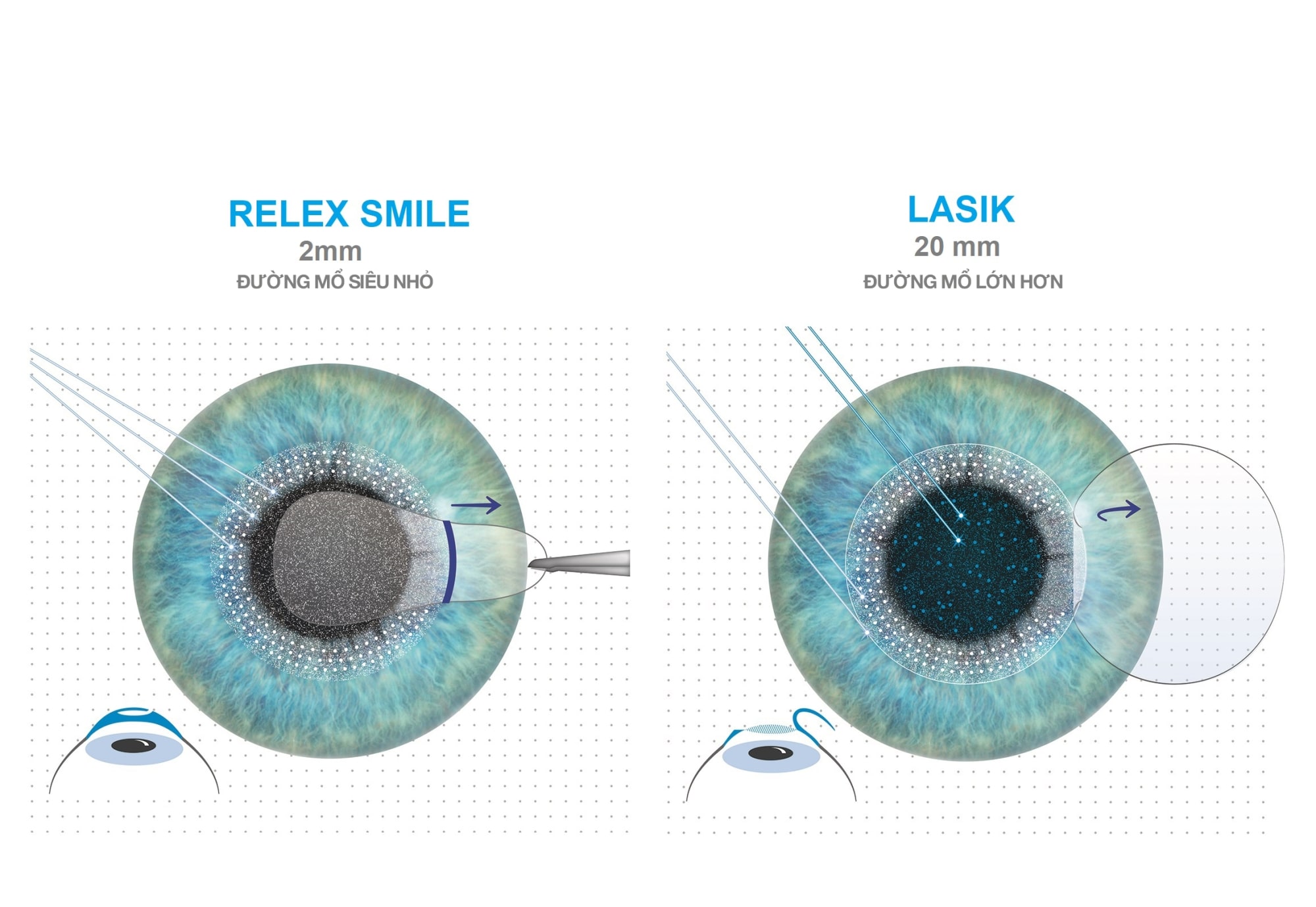 Phương pháp điều trị mắt cận bằng laser ReLEx Smile 