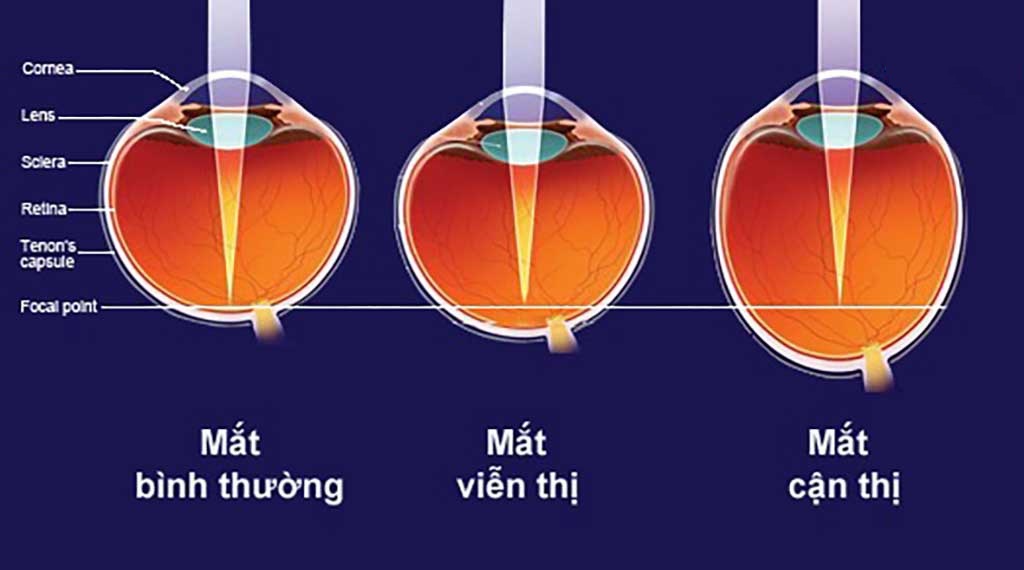 Phân biệt cận thị và viễn thị để tránh sai lầm thường gặp khi chữa cận thị viễn thị