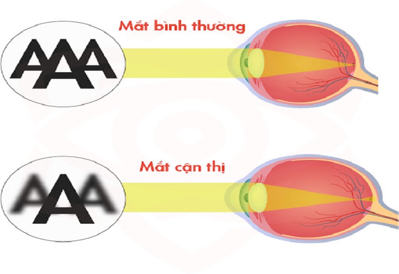 Tìm hiểu về tật khúc xạ cận thị