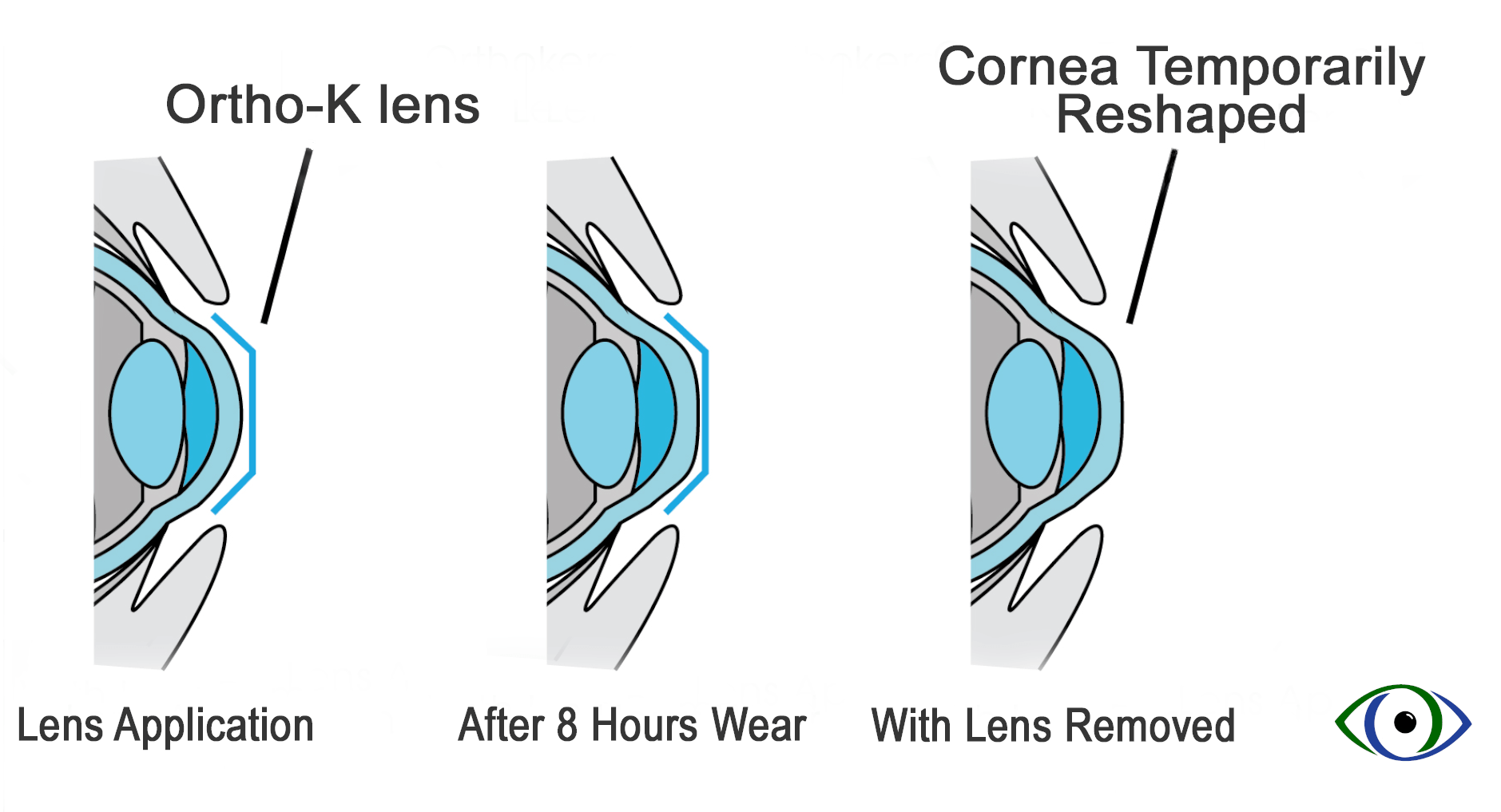 Cơ chế hoạt động của ortho-k