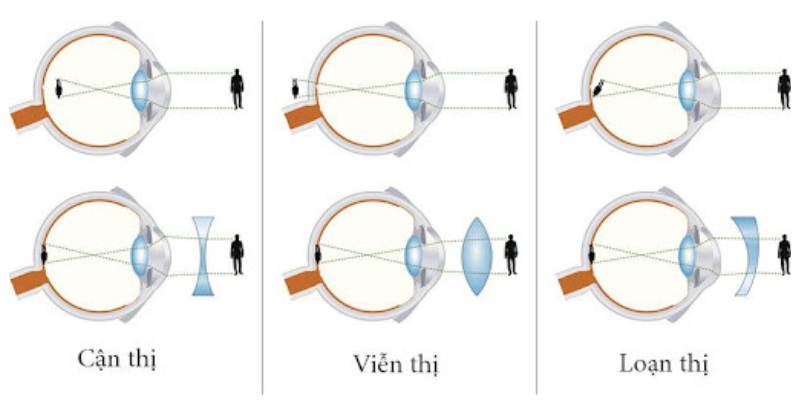 Trẻ bị viễn loạn có nên đeo kính thường xuyên không?