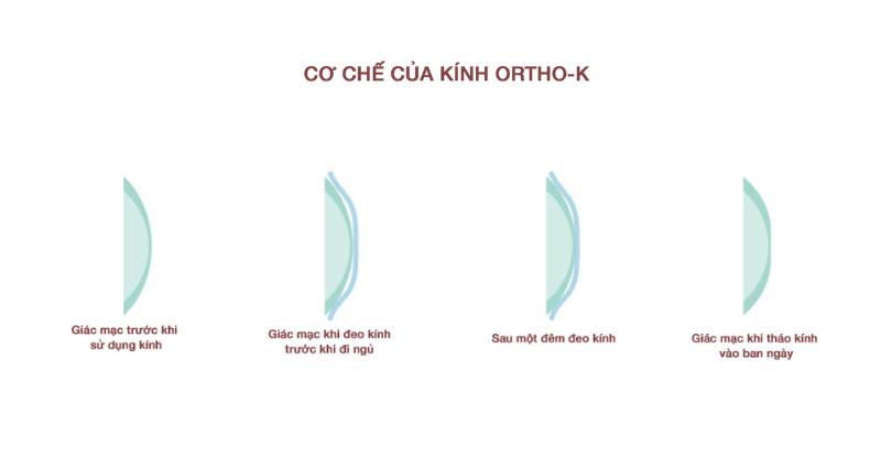 Ortho-K là phương pháp điều trị viễn loạn thị