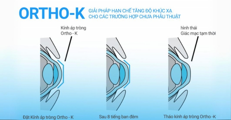 Không phải trẻ nào cũng phù hợp với kính Ortho-K