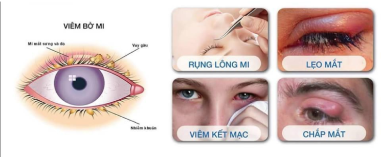 Triệu chứng viêm bờ mi