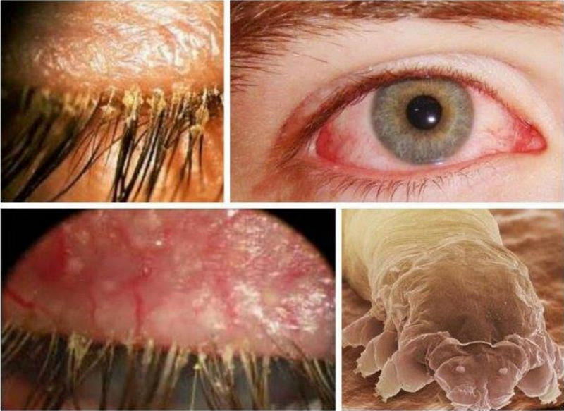 Viêm bờ mi do Demodex