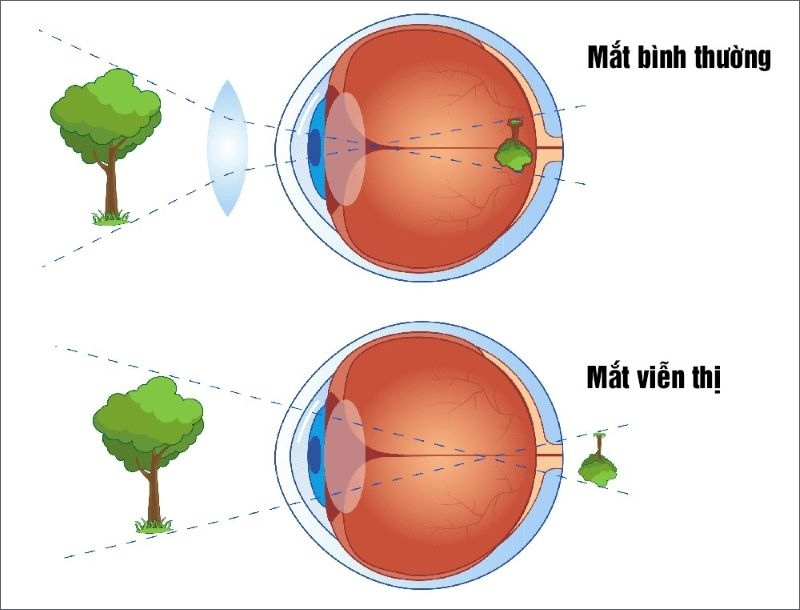 Mắt bình thường và mắt viễn thị ảnh hưởng tầm nhìn