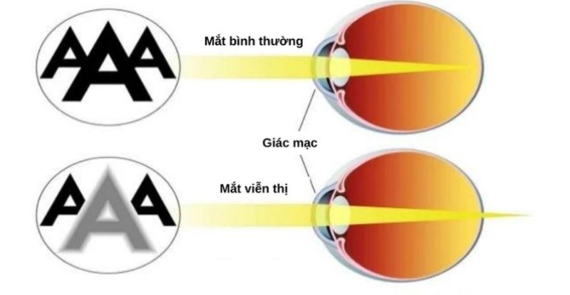 Mắt viễn thị có bị cận thị được không?