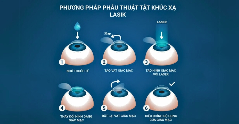 Các bước phẫu thuật tật khúc xạ bằng phương pháp LASIK