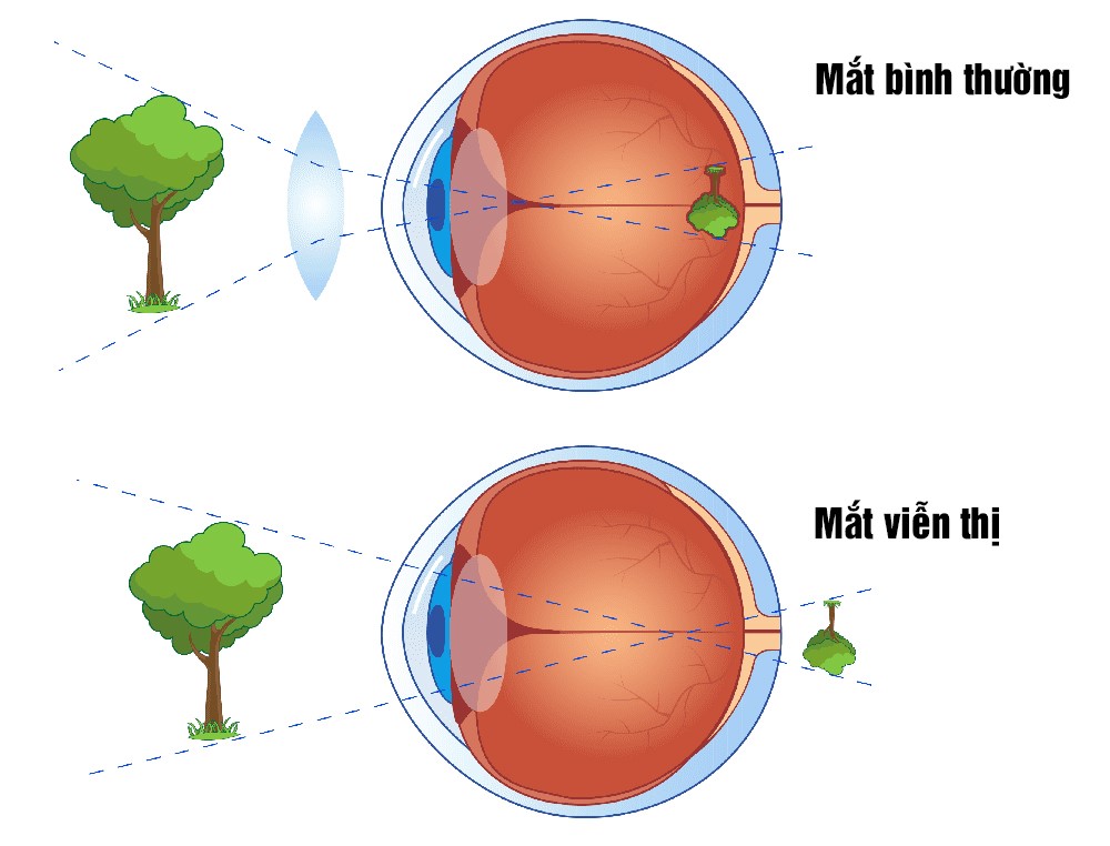 Mắt bị viễn thị nhìn thấy hình ảnh như nào?