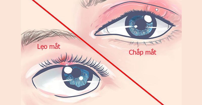 Cần kiêng gì sau chích chắp lẹo là câu hỏi mà nhiều người quan tâm