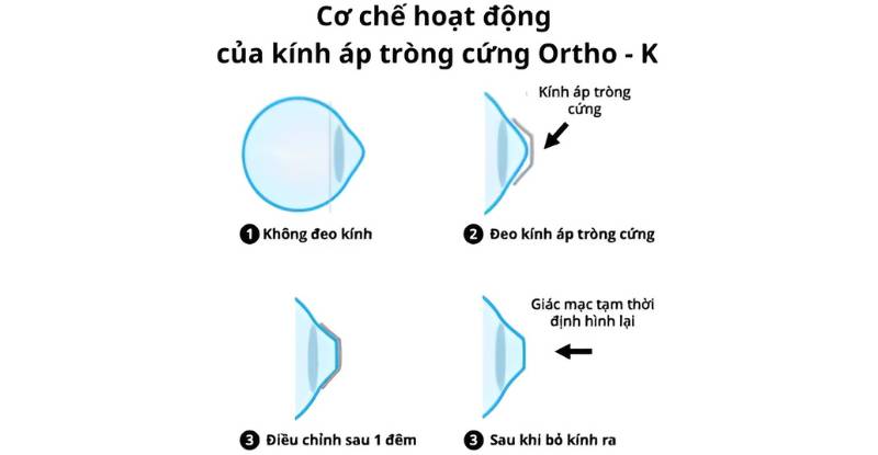 Kính áp tròng cứng Ortho-K hoạt động theo cơ chế điều chỉnh tạm thời hình dạng của giác mạc trong khi người dùng ngủ