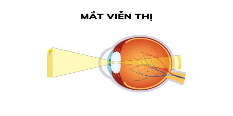 Viễn thị là gì?