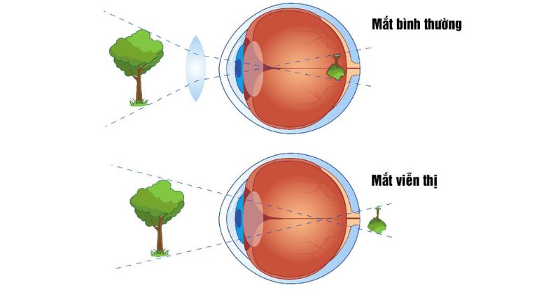 Viễn thị nặng ở trẻ nhỏ là tình trạng mà mắt không thể điều tiết để nhìn rõ các vật thể ở cả gần lẫn xa