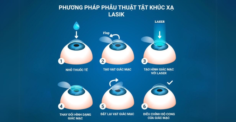 Các bước phẫu thuật Lasik