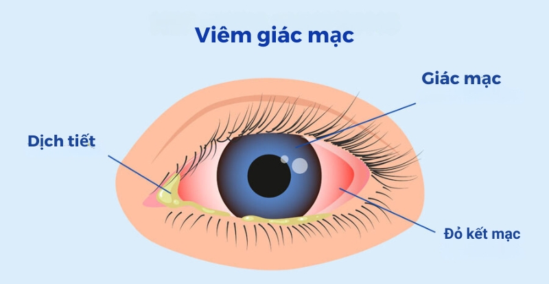 Biết cách đeo kính áp tròng đúng giúp giảm nguy cơ nhiễm trùng mắt như viêm giác mạc