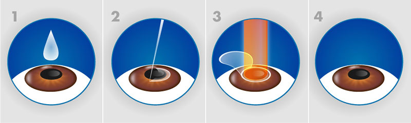 Quy trình phẫu thuật Lasik