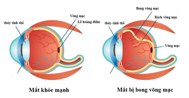 Biến chứng của cận thị