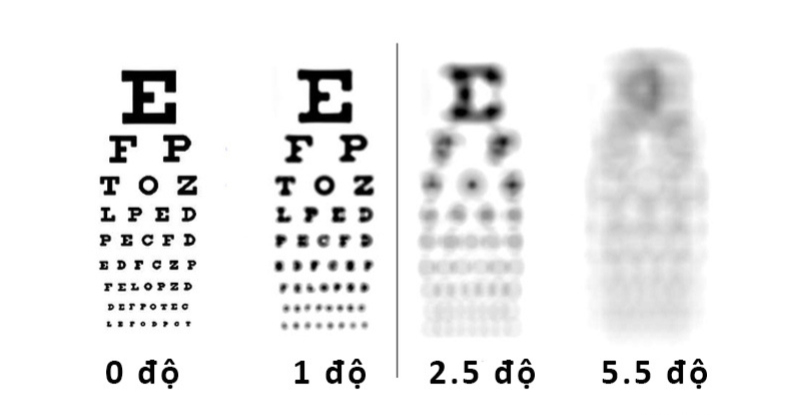 Việc đeo kính cận sai số có thể làm độ cận tăng nhanh hơn bình thường