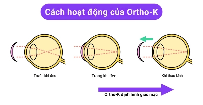 Cơ chế hoạt động của kính Ortho-K