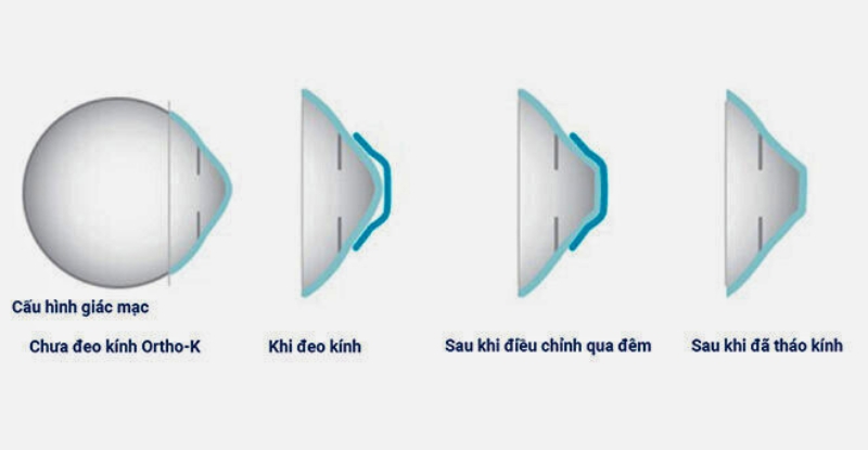 Cách kính Ortho-K định hình giác mạc