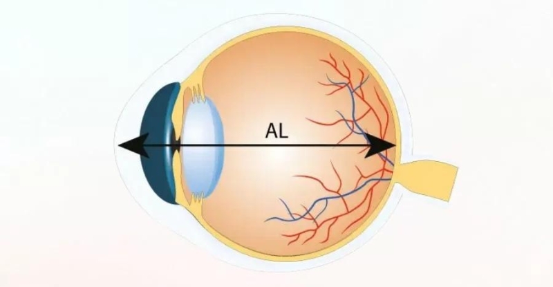 Đo chiều dài trục mắt giúp đánh giá tiến triển cận thị