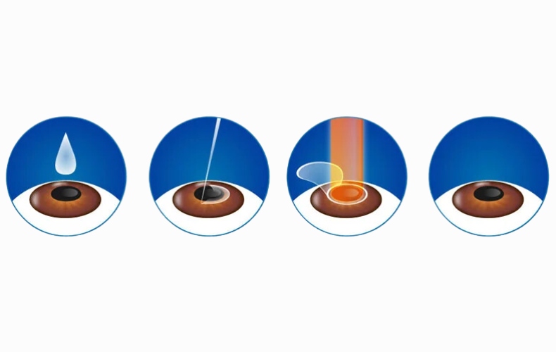 Phương pháp phẫu thuật mắt Lasik