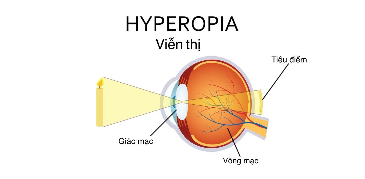 Tật khúc xạ viễn thị