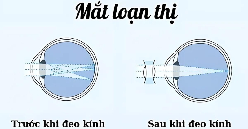 Đeo kính điều trị loạn thị bẩm sinh bằng cách điều chỉnh cách ánh sáng hội tụ