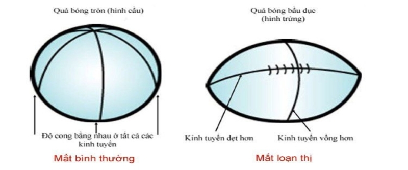 Mắt loạn thị so với mắt bình thường