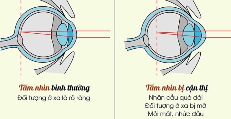 Mắt bình thường và mắt cận thị