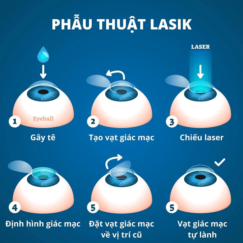 Phẫu thuật LASIK điều trị mắt cận thị