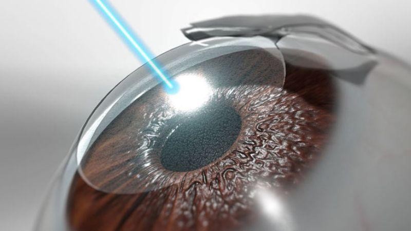 Hình ảnh minh họa phương pháp mổ Lasik