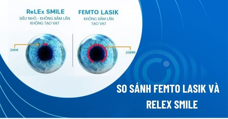 So sánh Relex Smile và Femto Lasik