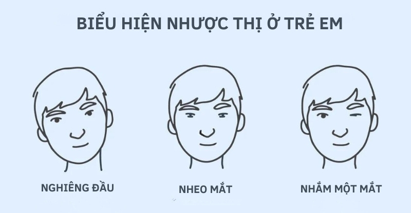 Một số biểu hiện nhược thị