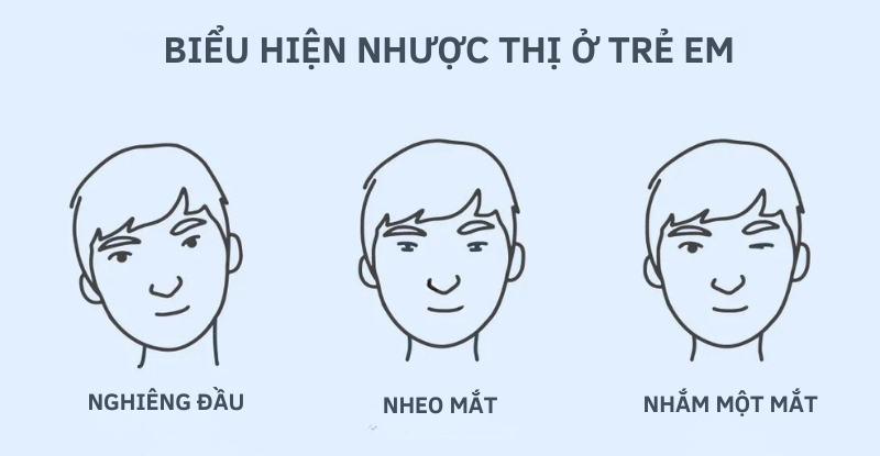 Biểu hiện nhược thị ở trẻ viễn thị