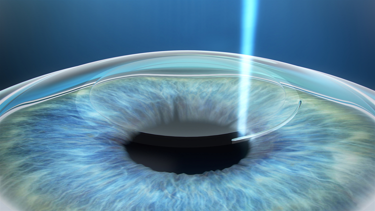 SBK LASIK là một phương pháp phẫu thuật khúc xạ phổ biến và hiệu quả.