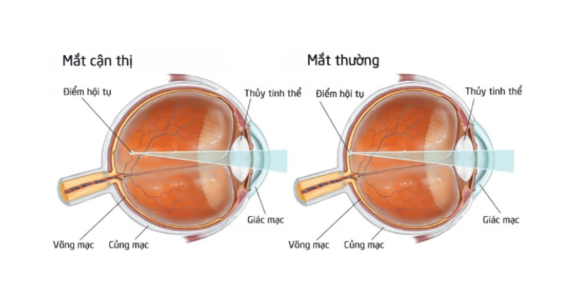 Mắt thường và mắt cận thị